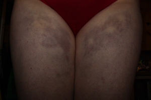 Did you know you could get frostbite on your thighs?  Lesson: wear pants.